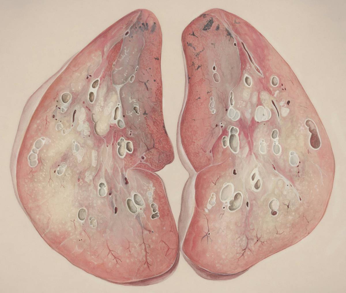 Screenshot of mobile app tracking progress in lung function